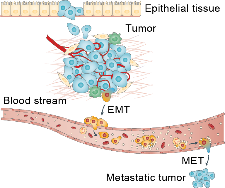 epithelial mesenchymal transition cancer